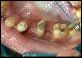 Good post hemisection healing seen