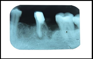 Radiographic evaluation after hemisection