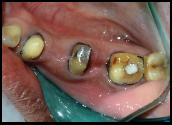Tooth preparation and gingival retraction was done with 44, mesial part of 46,47
