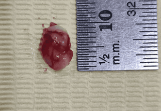 Excised tissue