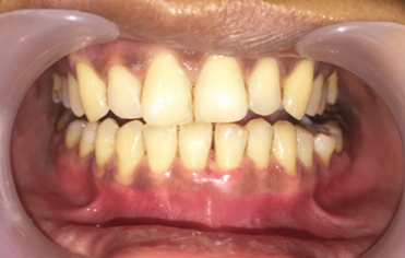 1 week Post-operative view