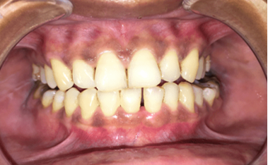 Months post-operative