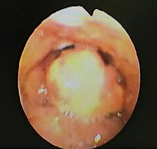 Flexiblelaryngoscopic view of the epiglottis at presentation