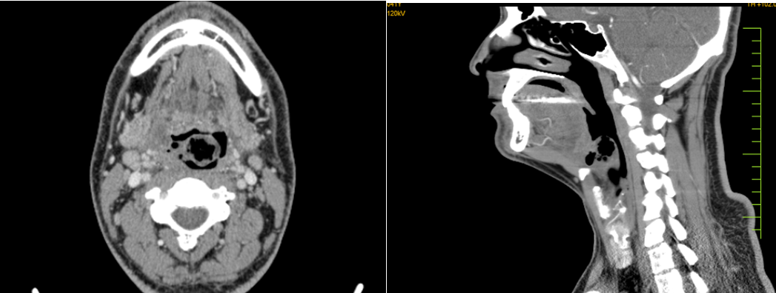 Contrast enhanced CT of the Neck