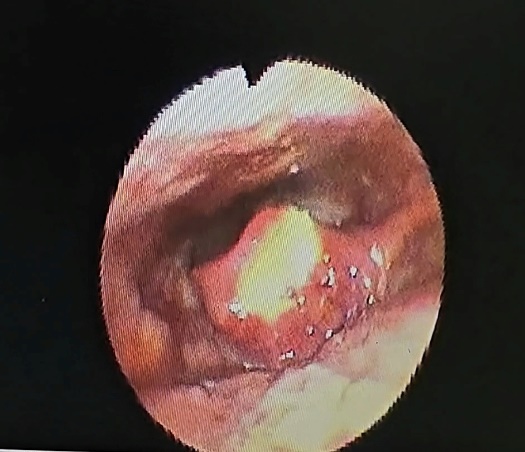 Flexiblelaryngoscopic image on POD 4