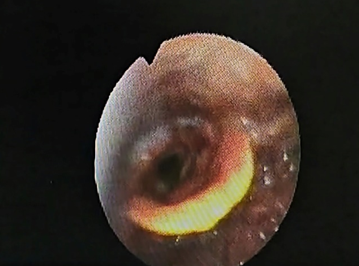 Flexiblelaryngoscopic image at 4 months post op