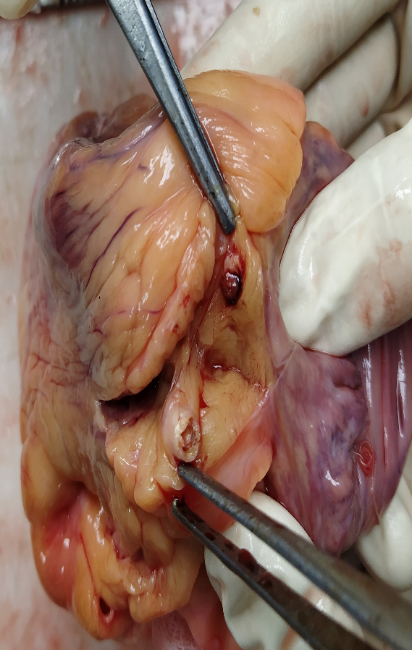 Showing 100% occlusion of right coronary artery