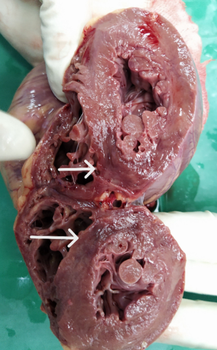 Showing hemorrhagic and soft myocardium