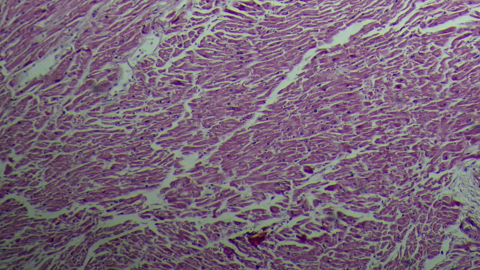Myocardium showing waviness of fibers with stromal edema suggestive of acute myocardial infarction. (H&E stain 10x)