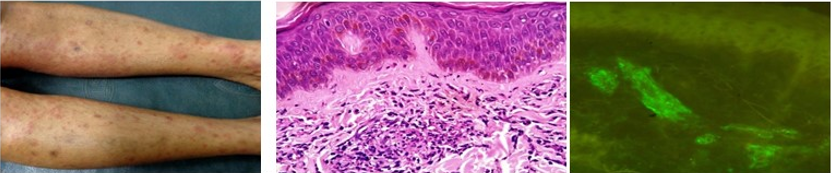 Multiple palpable pruritic rashes over lower extremities. H&E: 10X: Dermal changes in case of vasculitis. DIF: 40X: Case of HSP showing IgA granular vessel wall deposits.