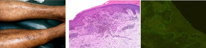 Multiplehyperpigmented plaque like lesions-lower extremities. H&E, 10X: Hypergranulosis, acanthosis and band like lymphocytic infiltrates. DIF: 10X: Shaggy fibrinogen deposits in the upper dermis.