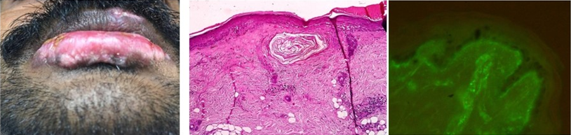 Atrophic, depigmented plaque with surrounding violaceous border. H&E: 10X: Follicular plugging, thickened basement membrane and Civette bodies. DIF: 40X: IgA in Linear and granular pattern along BMZ and vessel wall.