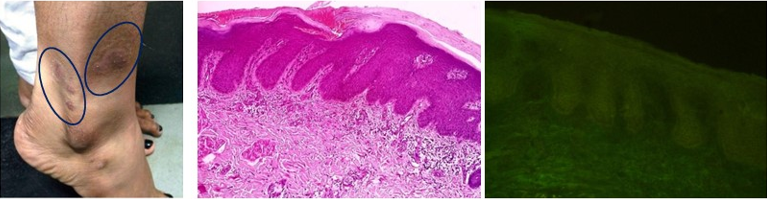 Scaly plaque like lesion over right lower limb. H&E: 20X: Parakeratosis, elongated rete ridges and psoriasiform hyperplasia. DIF: 20X: Negative DIF findings.