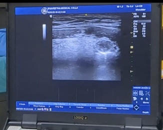 Showing SLN block