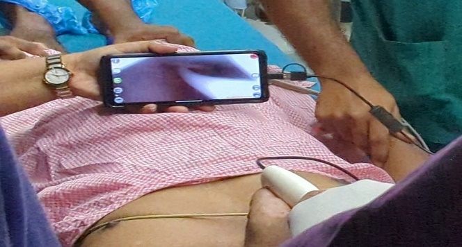 Indigenously made video laryngoscope showing the passage of flexible bronchoscope into the glottis