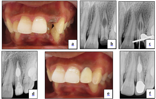 Internal inflammatory root resorption, a: Eli’s class IV fracture of tooth 22, pre-operative view, b: Preoperative IOPA R/F depicting large oval radiolucency in middle 1/3rd of root of tooth 22, c: IOPA R/F depicting determination of working length, d: Post-operative IOPA R/F view showing MTA plug, Post and core restoration with prefabricated fibre post (Angelus, Brazil) and composite resin core build-up, e: Prosthetic rehabilitation of tooth 22 with Porcelain fused metal (PFM) crown, f: Post-operative IOPA R/F 6 month follow-up