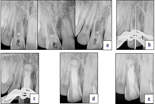Perforating internal inflammatory root resorption, a: Pre-operative IOPA R/F depicting ‘perforating internal root resorption’ at different angulations, b: IOPA R/F depicting establishment of working length, c: IOPA R/F showing MTA plug, d: Post-operative IOPA, e: Post-operative IOPA after one year.