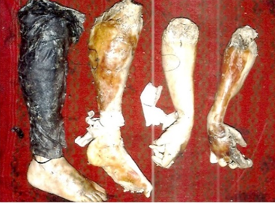 Both the fore limbs & fore arm sharplt amputated and showing adiposis changes indicating found in water, right leg also having salwar