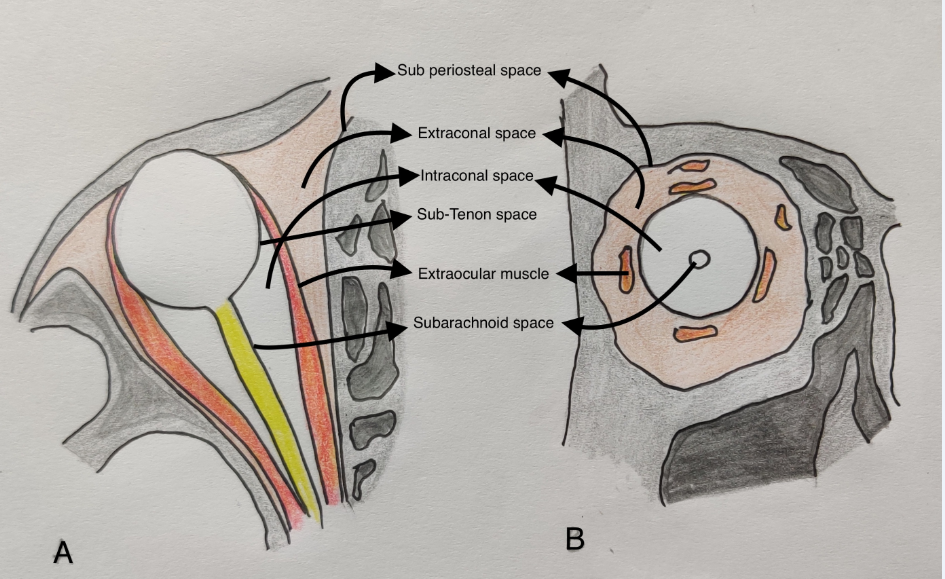Sketch diagram ofaxial and coronal sections of the orbit showing various surgical spaces.