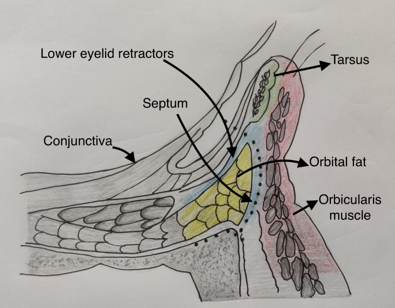 The incision is carried through the insertion of the lower lid retractors and then inferiorly towards the orbital rim.