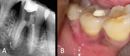 A:-Calcium hydroxide placed in canals, B: the swelling subsided completely 1 week after the initial endodontic procedures.