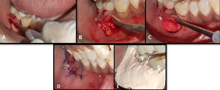 A: -bony defect after elevation of full thicknessmucoperiosteal flap and curettage of granulation tissue, B: -placement of β-TCP graft, C:- GTR membrane placed, D:- surgical site sutured with 4-0 vicryl, E:- Coe pack placed to protect the surgical site.