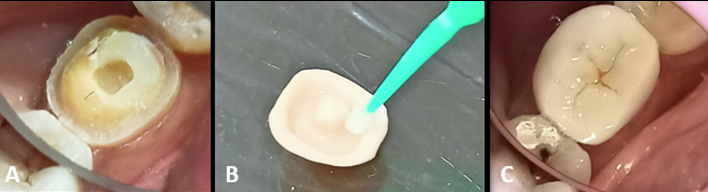 A:- Tooth preparation for endocrown, B:-10-MDP based tetric N-bond universal applied on the intaglio surface of the zirconia prosthesis, C:- Endocrown cemented