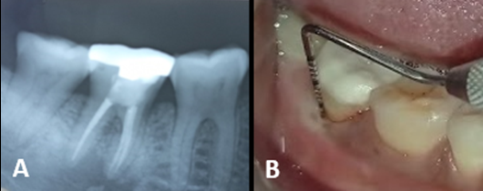 A:- IOPAR at 6 month follow up time period, B:- reduced probing depth (midbuccal-1mm)