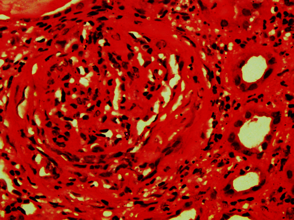 Shows focal cellular crescent at 6 O’clock position whereas in other part it is fibrocellular. (H&E X 400)