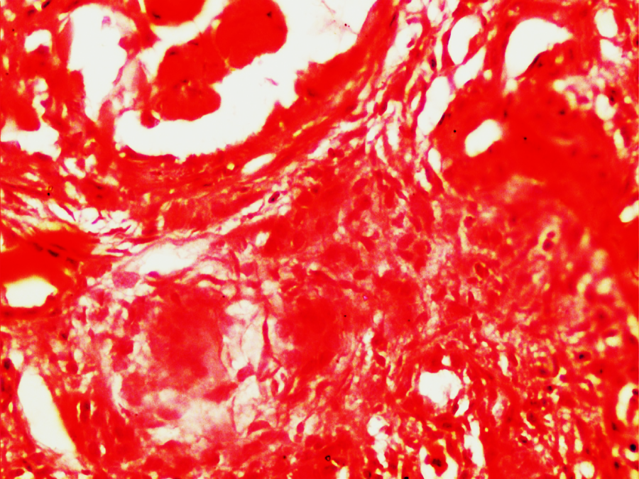 Showing small non caseating granuloma in periglomerular area of wegener’s granulomatosis. (H&E X400)