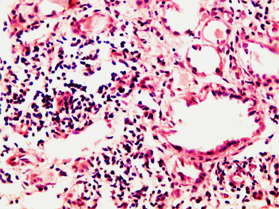 Showing severe vasculitis of peritubular capillaries in MPA with mononuclear cell infiltration on the left side but medium sized blood vessel on right side does not show vasculitis (H&E X 400)