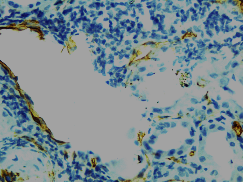CD34 staining of venulitis showing destruction of endothelial cells (loss of CD34 staining) & heavy MNC infiltration. (IP staining with CD34 X400)