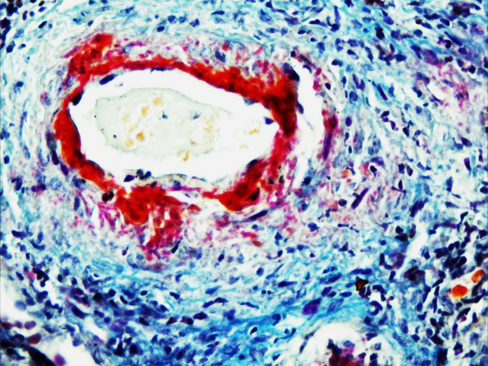 Showing fibrinoid necrosis of vessel wall (red colour), vasculitis & hyaline thrombi in lumina. (AFOG X 400)