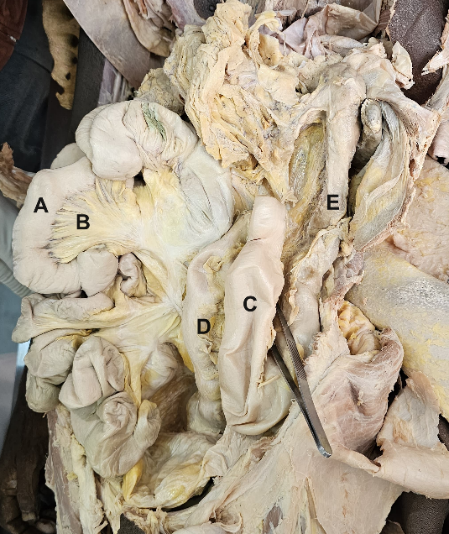 Descending and sigmoid colon after shifting small intestine to right [A: Small intestine; B: Mesentery of small intestine; C: Ascending limb of redundant Sigmoid colon; D: Descending limb of redundant Sigmoid colon; E: Descending colon.]