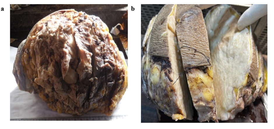 Primary Breast Sarcoma: A Diagnostic Conundrum