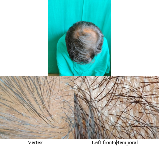 Group Minoxidil fortified with finasteride: Patient 1: Intial picture (Dermascope).