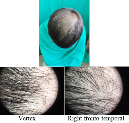 Group PRP: Patient 1: Picture after 6 months.