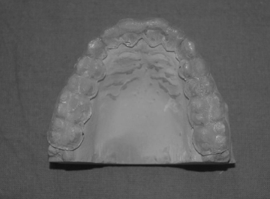 Prepared maxillary occlusal splint