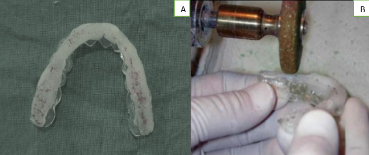 Occlusal adjusted of flat maxillary occlusal splint –A-Occlusal view of flat maxillary occlusal splint with marked high points and excess acrylic surrounding the centric contact removed with a hard rubber wheel on a lathe