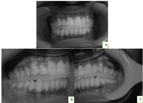 A well –adjusted maxillary flat occlusal splint with even contacts everywhere A: frontal view: B, C- Lateral