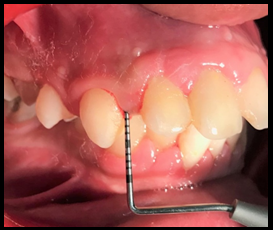 Baseline measurement 