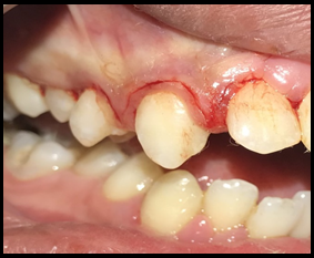 Reverse bevel incision