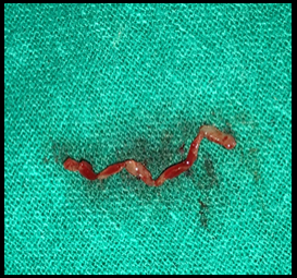 Excised Gingival Lining 