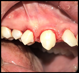 Debridement