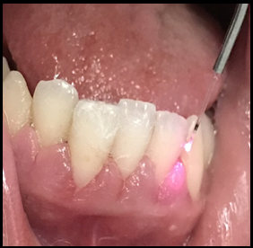 Application of laser