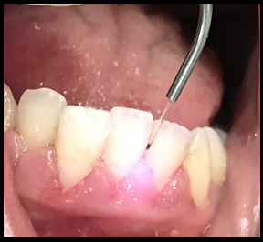 After Laser tip inserted
