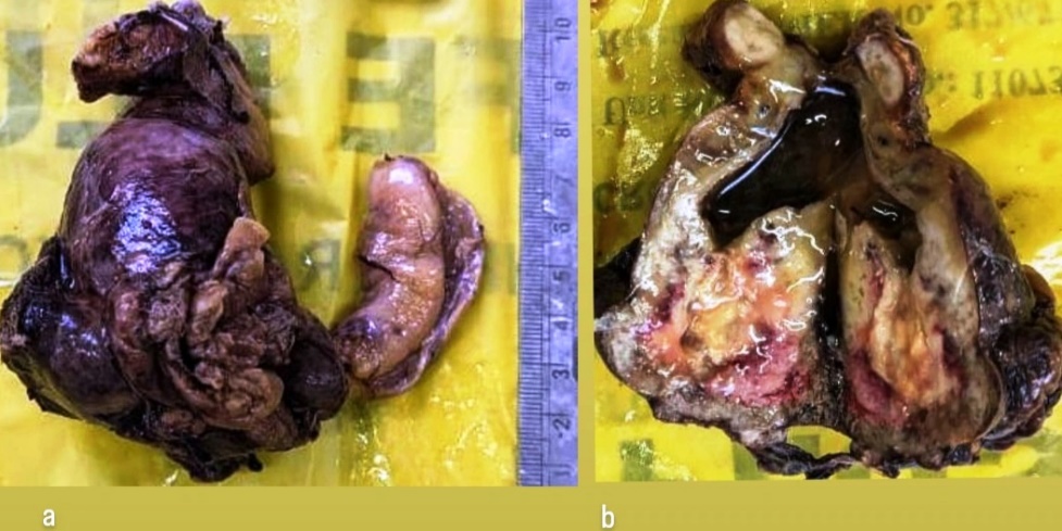 a): Gross gall bladder measured 8.2 × 5.2 × 3 cm with mass; b): Cut open gall bladder showing grey white to tan white, irregular, friable tumor with mucoid material
