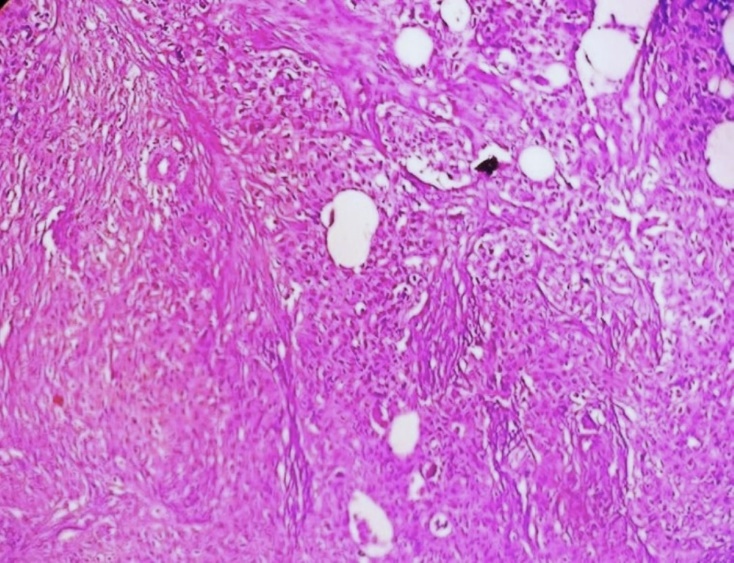 Photomicrograph showing tumor infiltration in gall bladder wall (H&E stain, ×400)