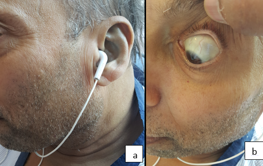 Clinical photograph, 1a: black pinna, 1b: black sclera