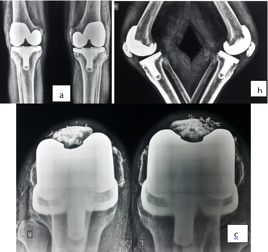 Postoperative radiograph of knees at 24 months, 5a: anteroposterior view, 5b: lateral view, 5c: skyline view. 